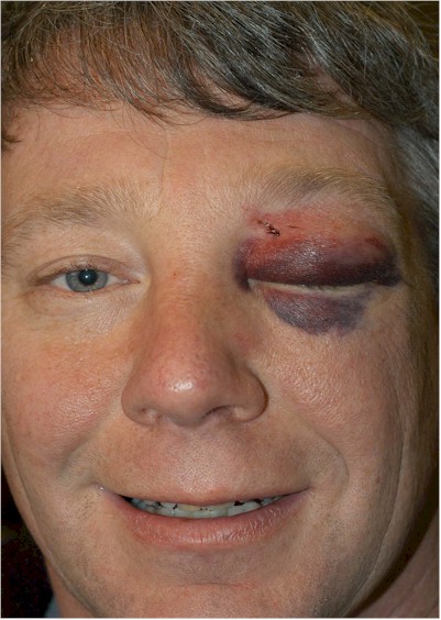 74053=4143-bob's black eye.jpg